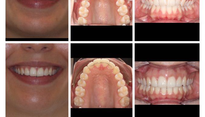 Amazing 6-month Smile Transformation